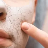 Nahaufnahme eines Gesichts mit trockener, rissiger Maske, auf die ein Finger tippt.