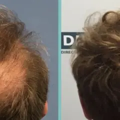 Biotin für Haare: Vorher-Nachher-Ergebnisse & realistische Erwartungen