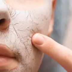 Nahaufnahme eines Gesichts mit trockener, rissiger Maske, auf die ein Finger tippt.