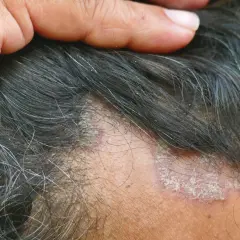 Schuppen im Haar: Ursachen, Behandlung & Hausmittel für gesunde Kopfhaut
