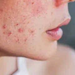 Sonnencreme für fettige Haut: Matt & pickelfrei? So geht's!