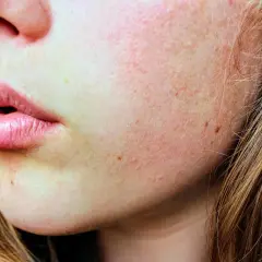 Nahaufnahme von Lippen und Wangen mit Sommersprossen und leicht geröteter Haut.