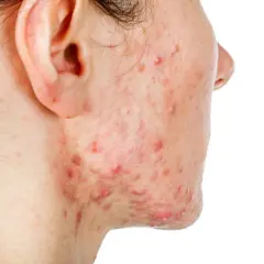 Juckende Pickel im Gesicht: Ursachen, Soforthilfe & langfristige Lösungen