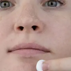 Nahaufnahme eines Gesichts mit stark schuppiger Haut, eine Hand trägt Creme auf.