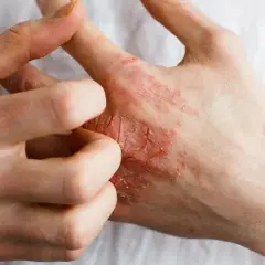 Gerötete Haut bei Männern: Ursachen, Hausmittel & effektive Tipps