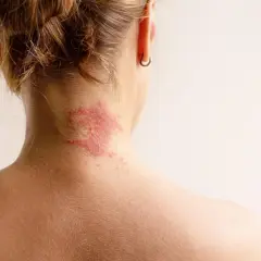 Rötliche, trockene Hautstellen am Nacken einer Frau.