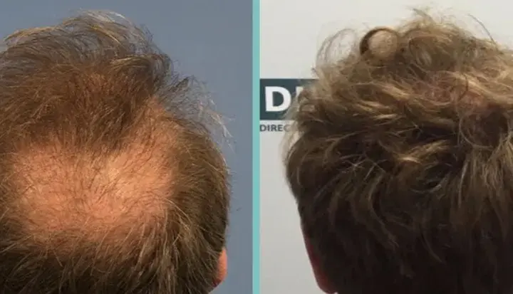 Biotin für Haare: Vorher-Nachher-Ergebnisse & realistische Erwartungen