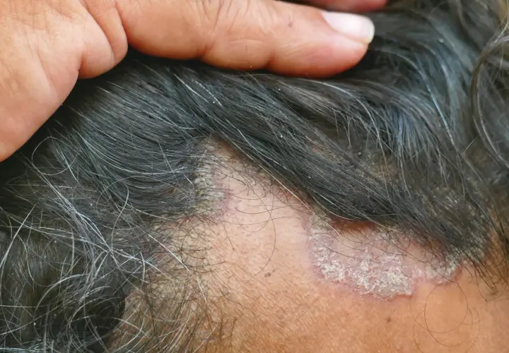 Schuppen im Haar: Ursachen, Behandlung & Hausmittel für gesunde Kopfhaut