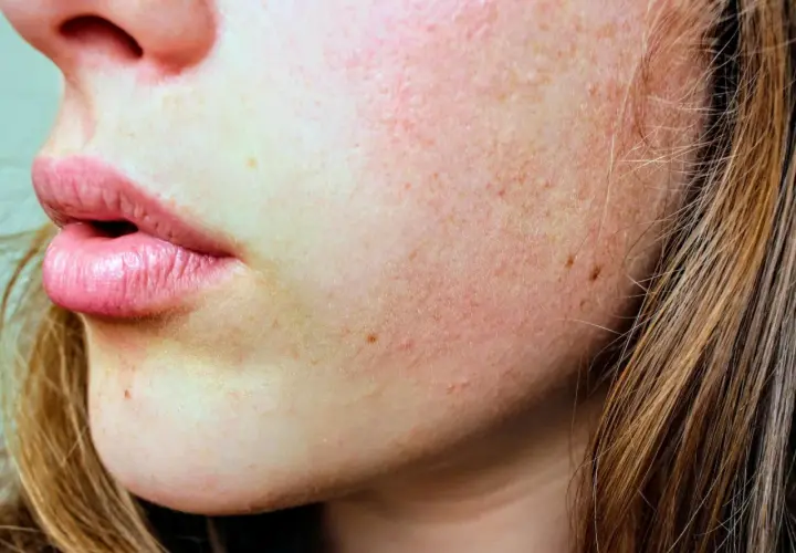 Nahaufnahme von Lippen und Wangen mit Sommersprossen und leicht geröteter Haut.