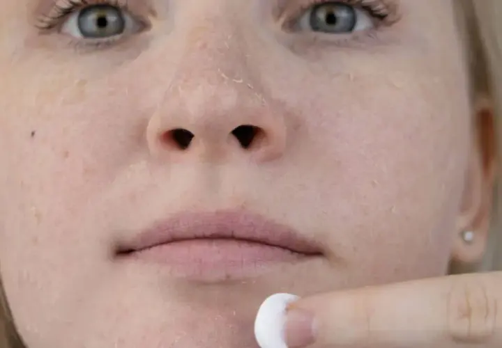 Nahaufnahme eines Gesichts mit stark schuppiger Haut, eine Hand trägt Creme auf.