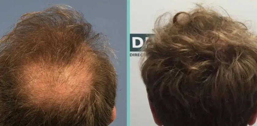 Biotin für Haare: Vorher-Nachher-Ergebnisse & realistische Erwartungen