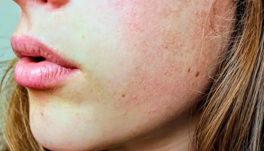 Nahaufnahme von Lippen und Wangen mit Sommersprossen und leicht geröteter Haut.