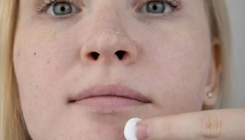 Nahaufnahme eines Gesichts mit stark schuppiger Haut, eine Hand trägt Creme auf.