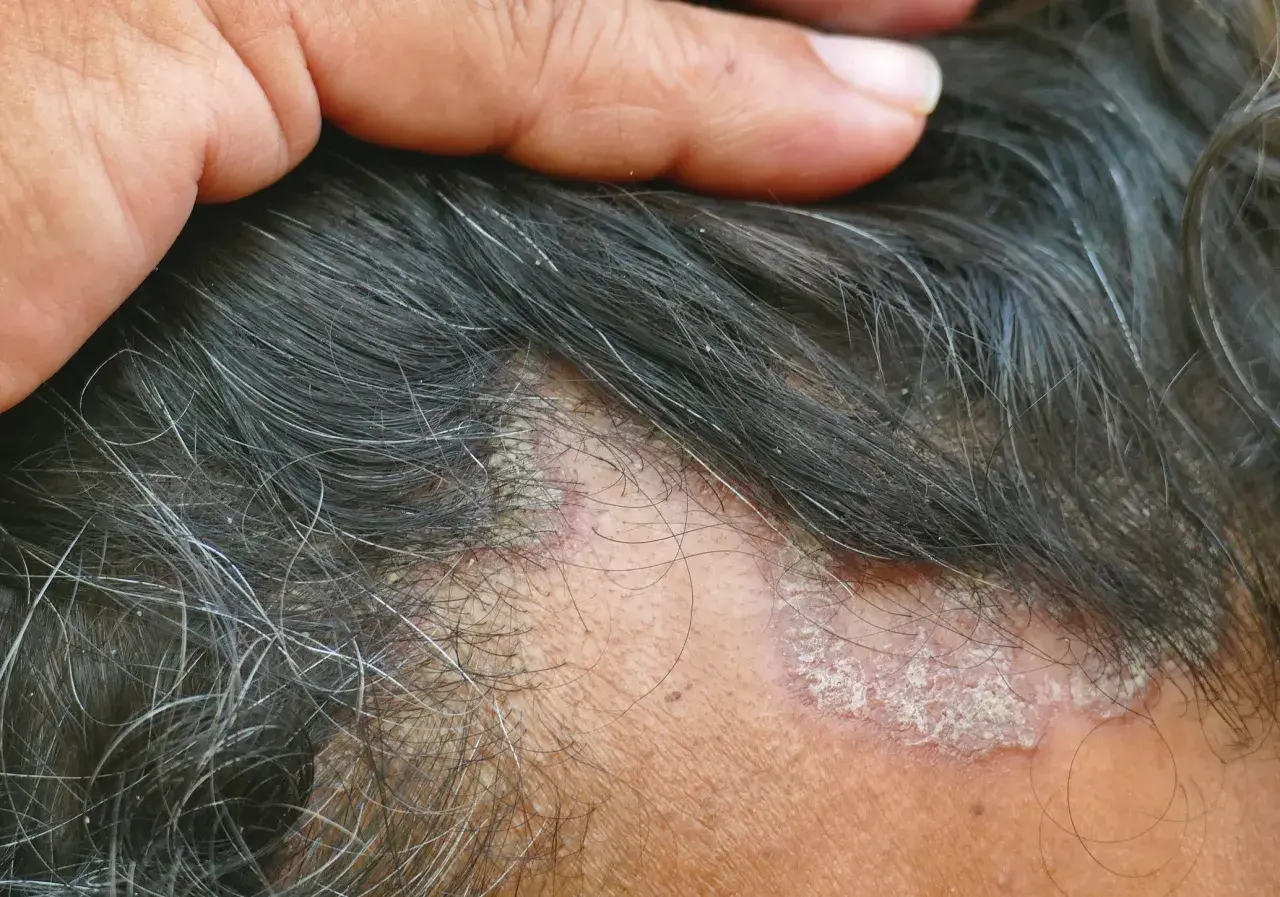 Schuppen im Haar: Ursachen, Behandlung & Hausmittel für gesunde Kopfhaut