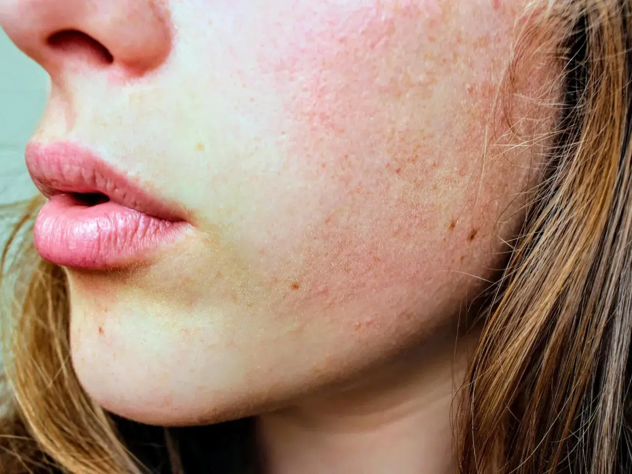 Nahaufnahme von Lippen und Wangen mit Sommersprossen und leicht geröteter Haut.