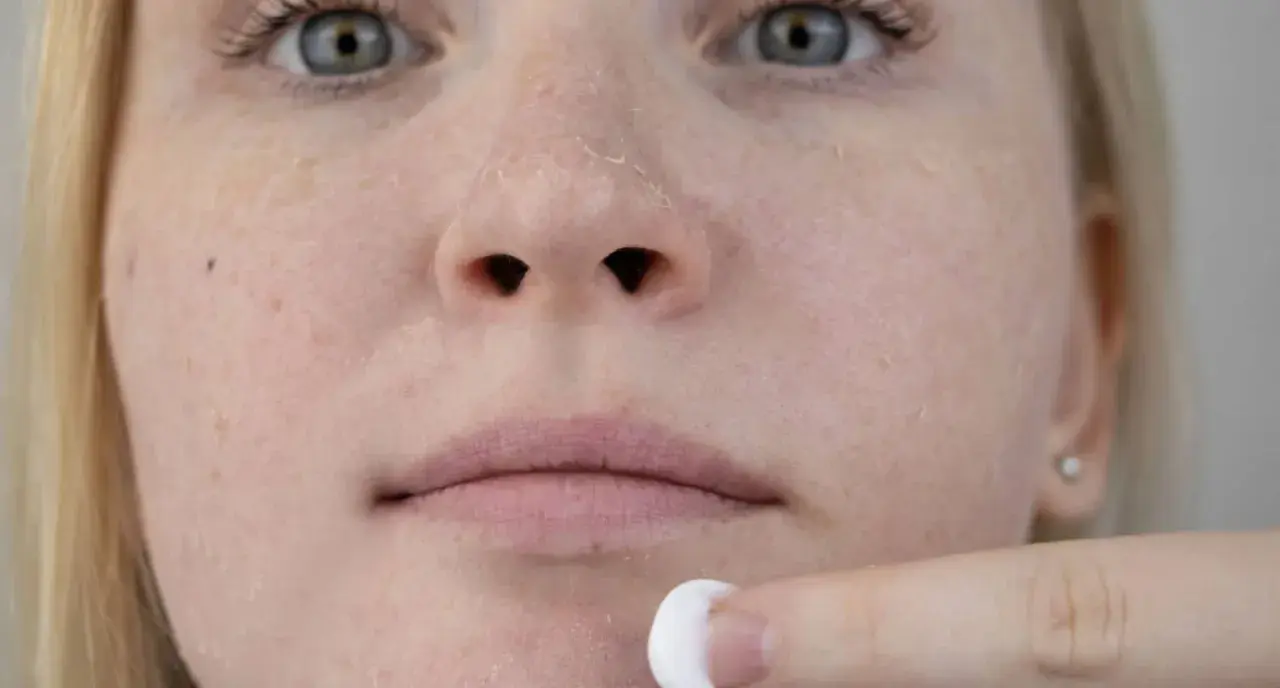 Nahaufnahme eines Gesichts mit stark schuppiger Haut, eine Hand trägt Creme auf.
