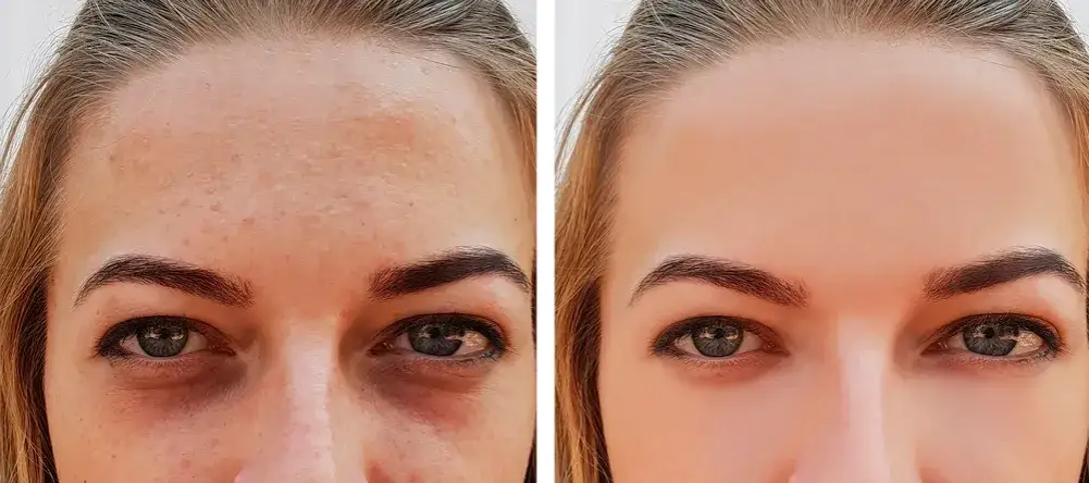 Microneedling Vorher Nachher