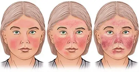 Rote Flecken Gesicht Ursachen