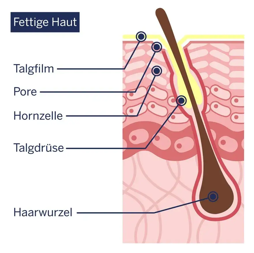 fettige Haut Ursachen Diagramm
