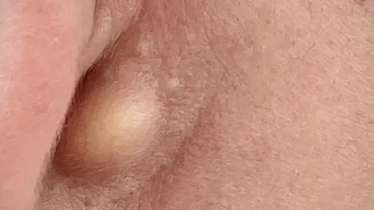 eingewachsenes haar intimbereich ursachen