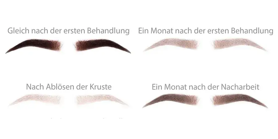 PMU Behandlungsablauf Schritte